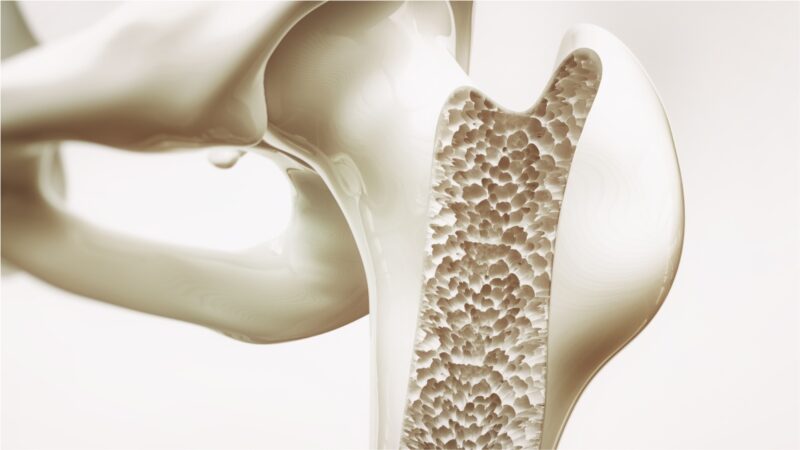 Menopausa e osteoporose: entenda a relação entre elas - Dra Natacha Machado - ginecologista Joinville